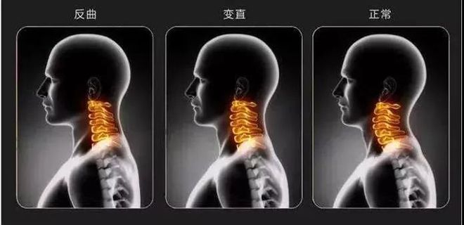 为什么你的脖子总是咔咔响！(图12)